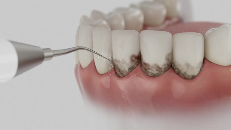 Trusted Wisdom Tooth Removal service in Herrin, IL - Dentist Open Now